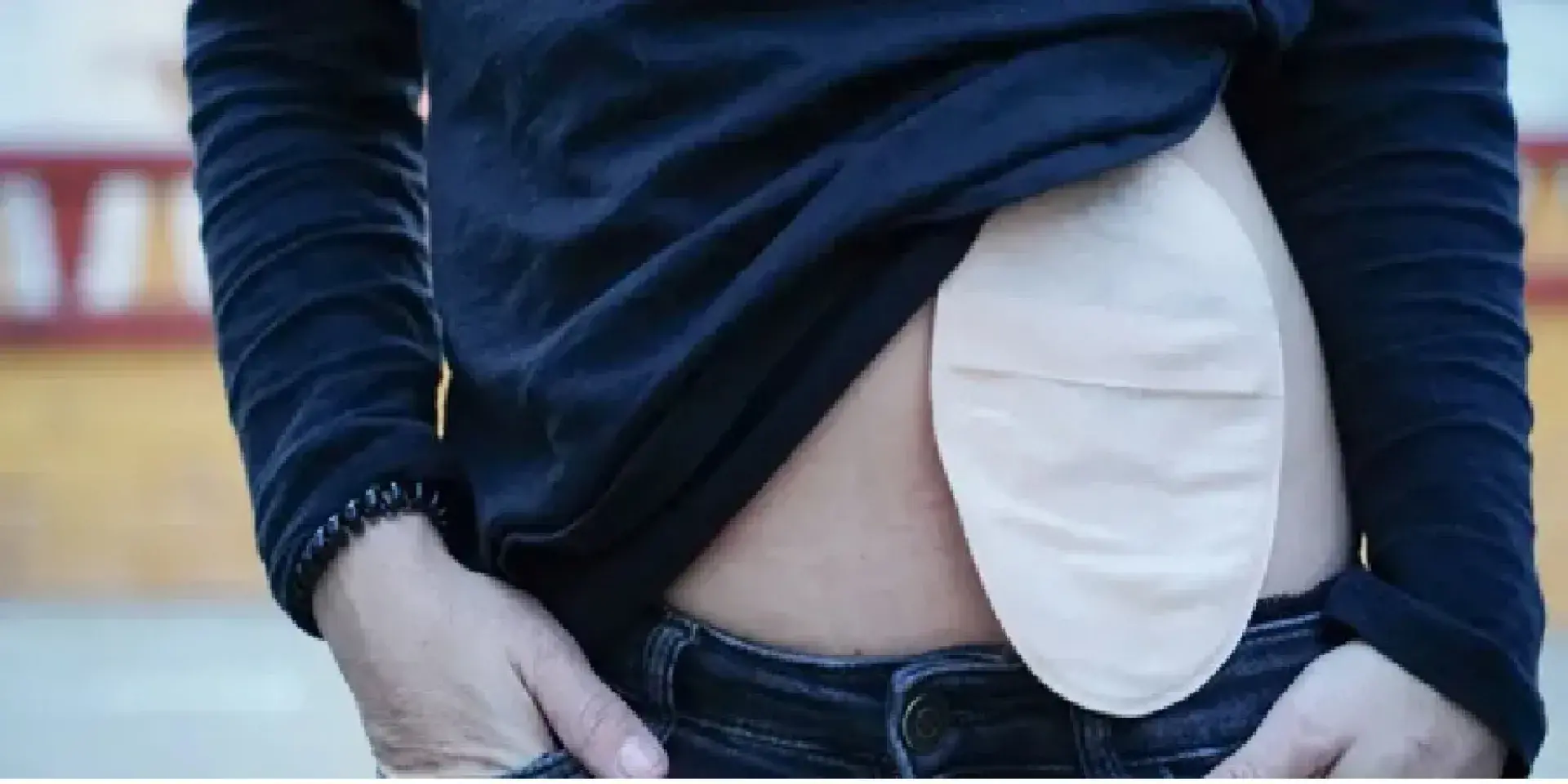 Stoma on person's stomach